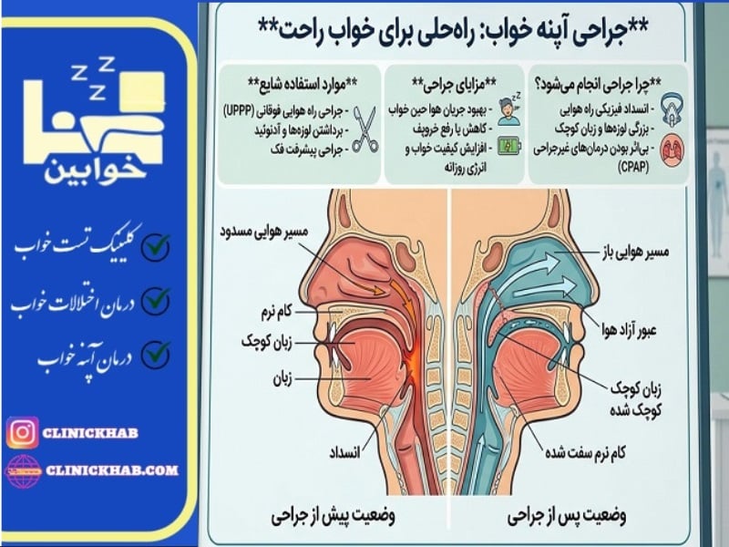 جراحی برای آپنه خواب