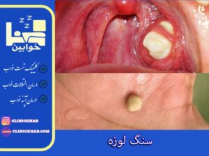 سنگ لوزه