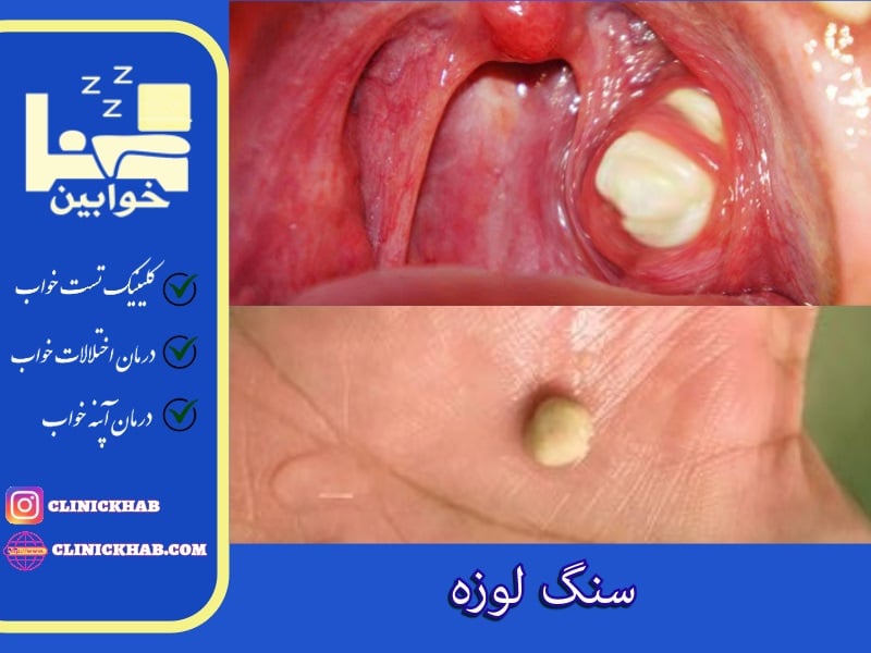 سنگ لوزه