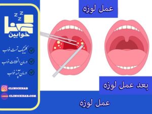 عمل لوزه