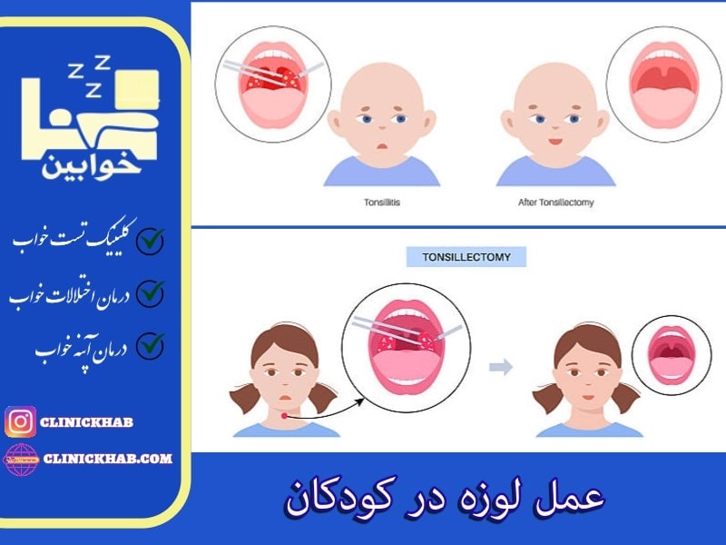 عمل لوزه در کودکان