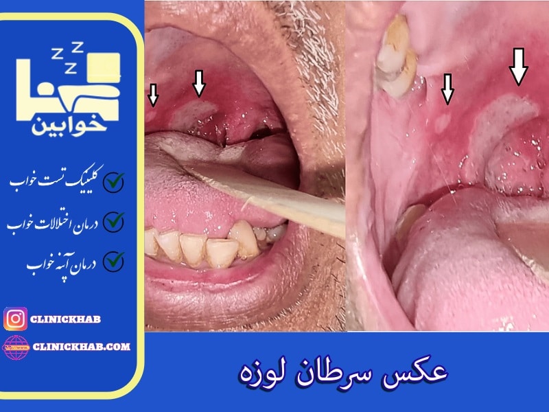 عکس سرطان لوزه