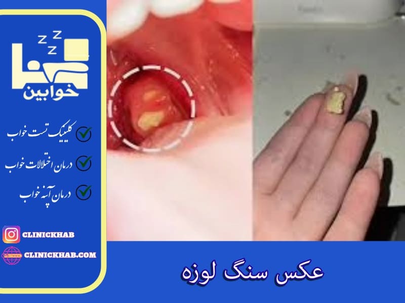 عکس سنگ لوزه