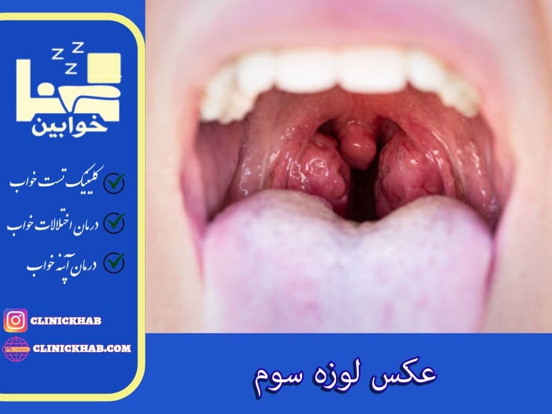 عکس لوزه سوم