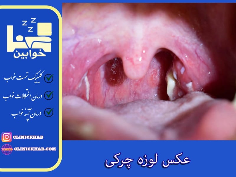 عکس لوزه چرکی